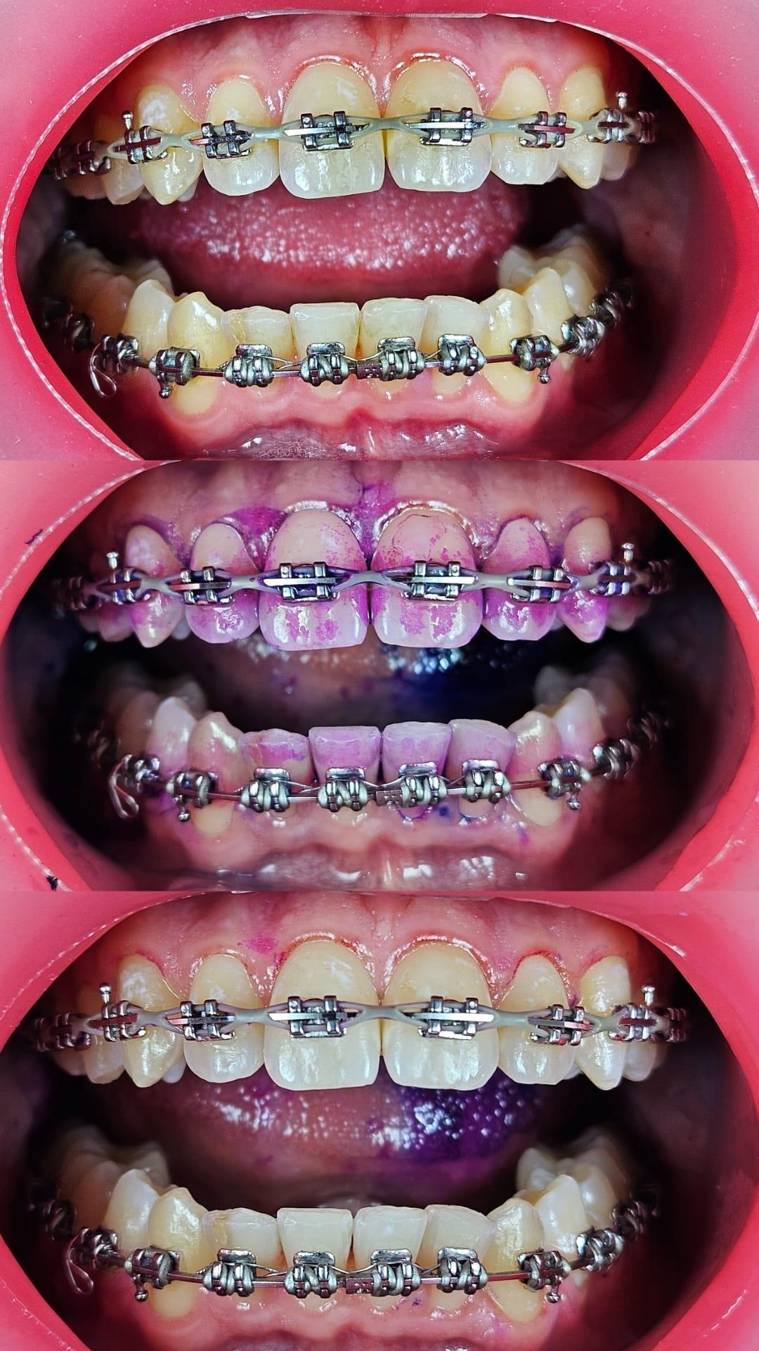 Retracción de labios y mejillas en odontología: técnicas, herramientas y buenas prácticas