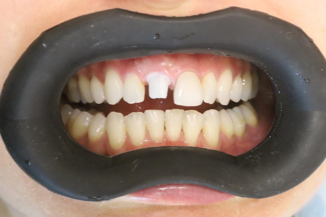 Fotografía dental con contrastador integrado
