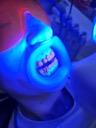 Blanqueamiento dental con el separador VisionButler